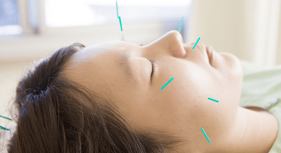 Be beautiful with acupuncture